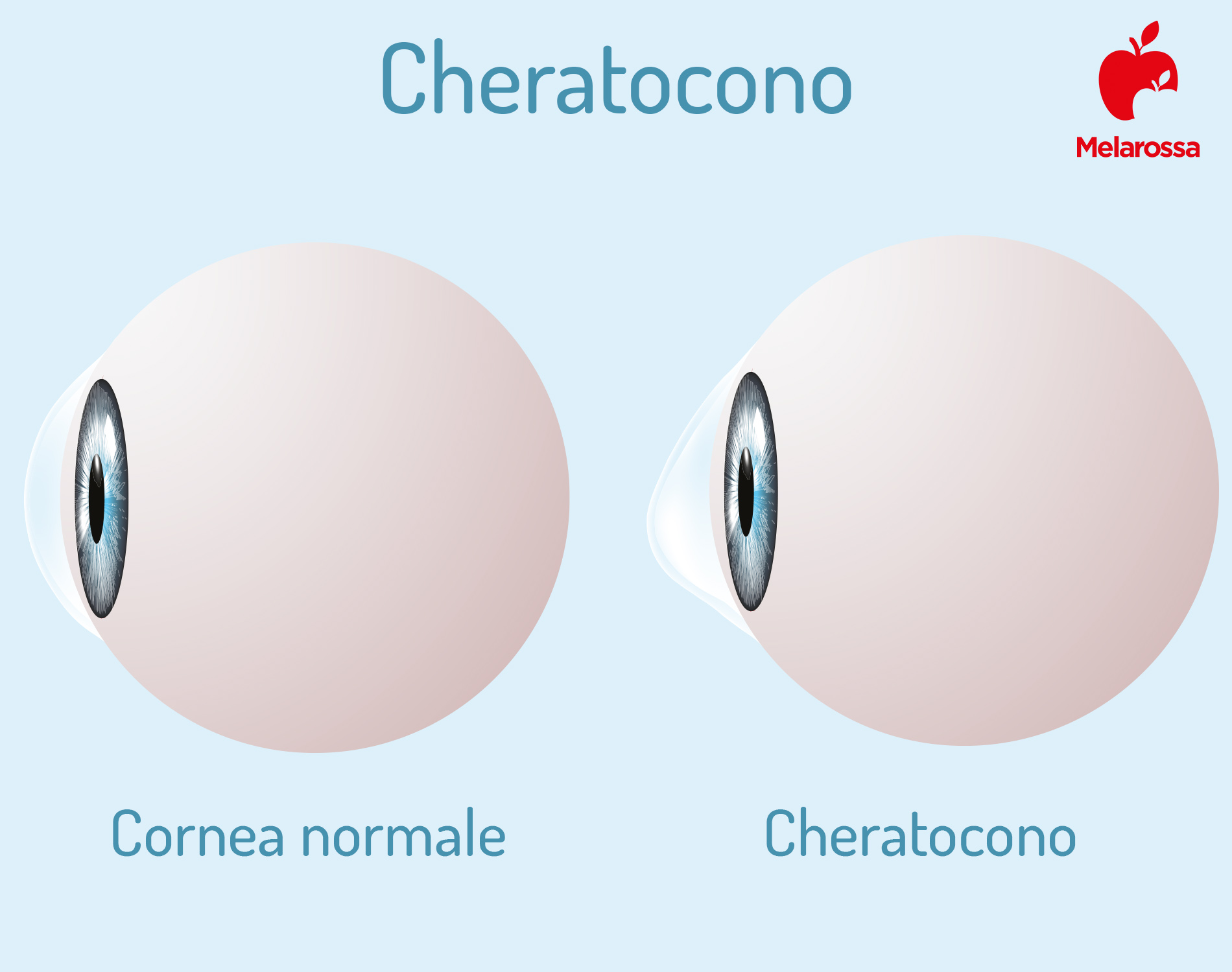 cheratocono:  foto