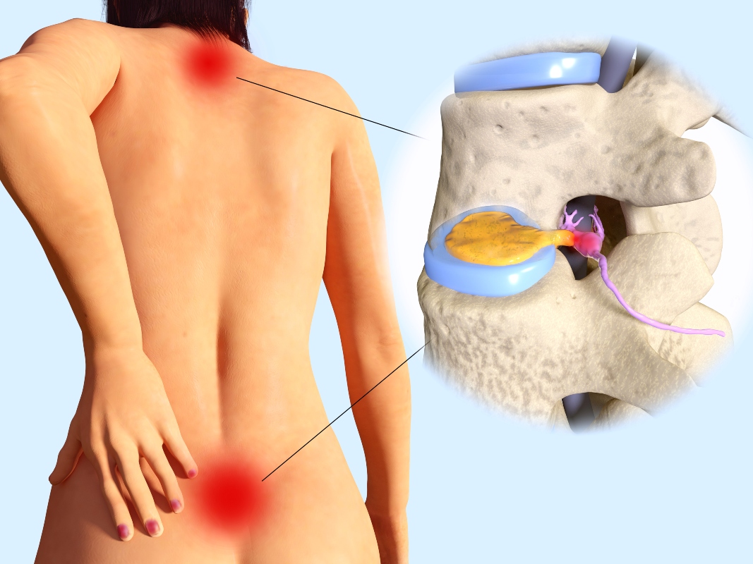 mal di schiena: discopatia lombare e cervicale- Foto 