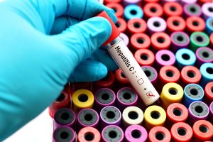 Epatite C: cos’è, cause e sintomi, contagio, fattori di rischio, diagnosi, cure e prevenzione