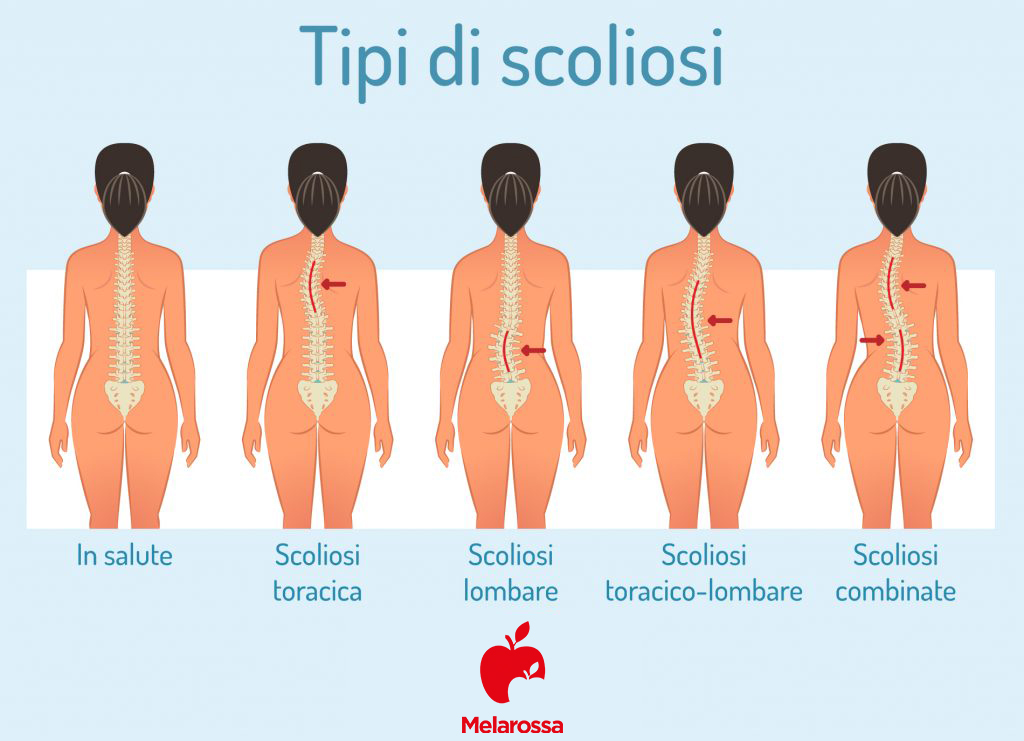 mal di schiena: tipi di scoliosi- INFOGRAFICA