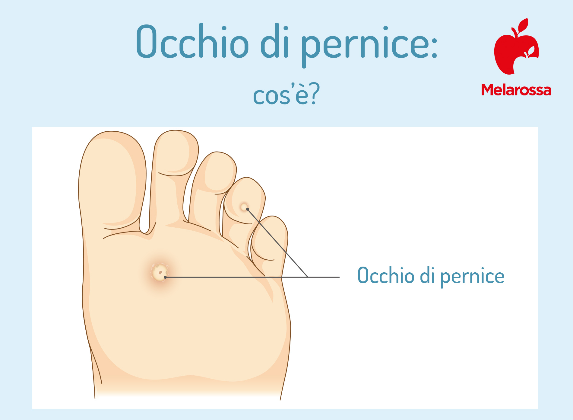 occhio di pernice: cos'è 