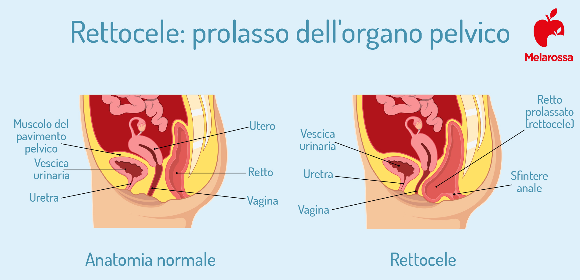 perineo: prolasso  vaginale 