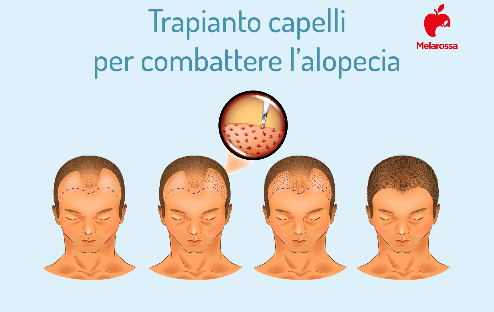 alopecia e trapianti di capelli 