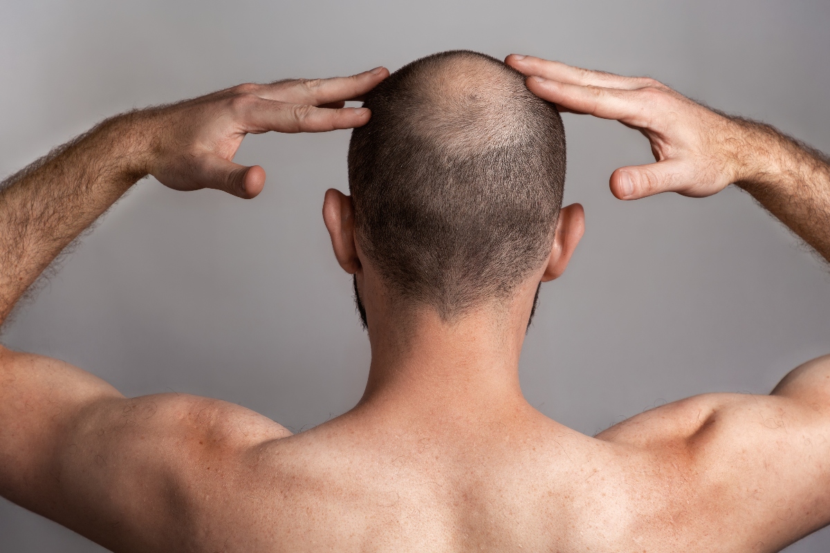 Alopecia: cure 