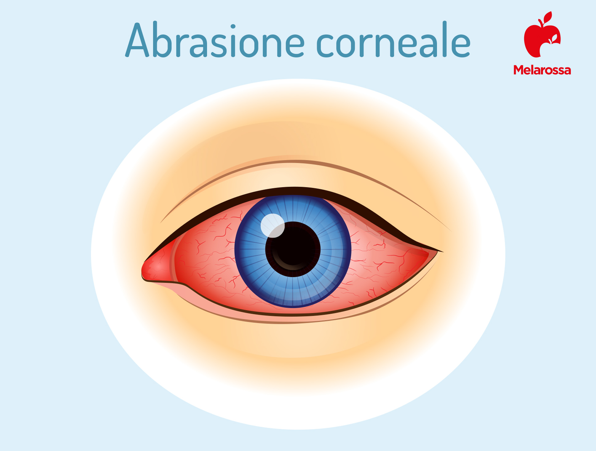 abrasione corneale: sintomi 