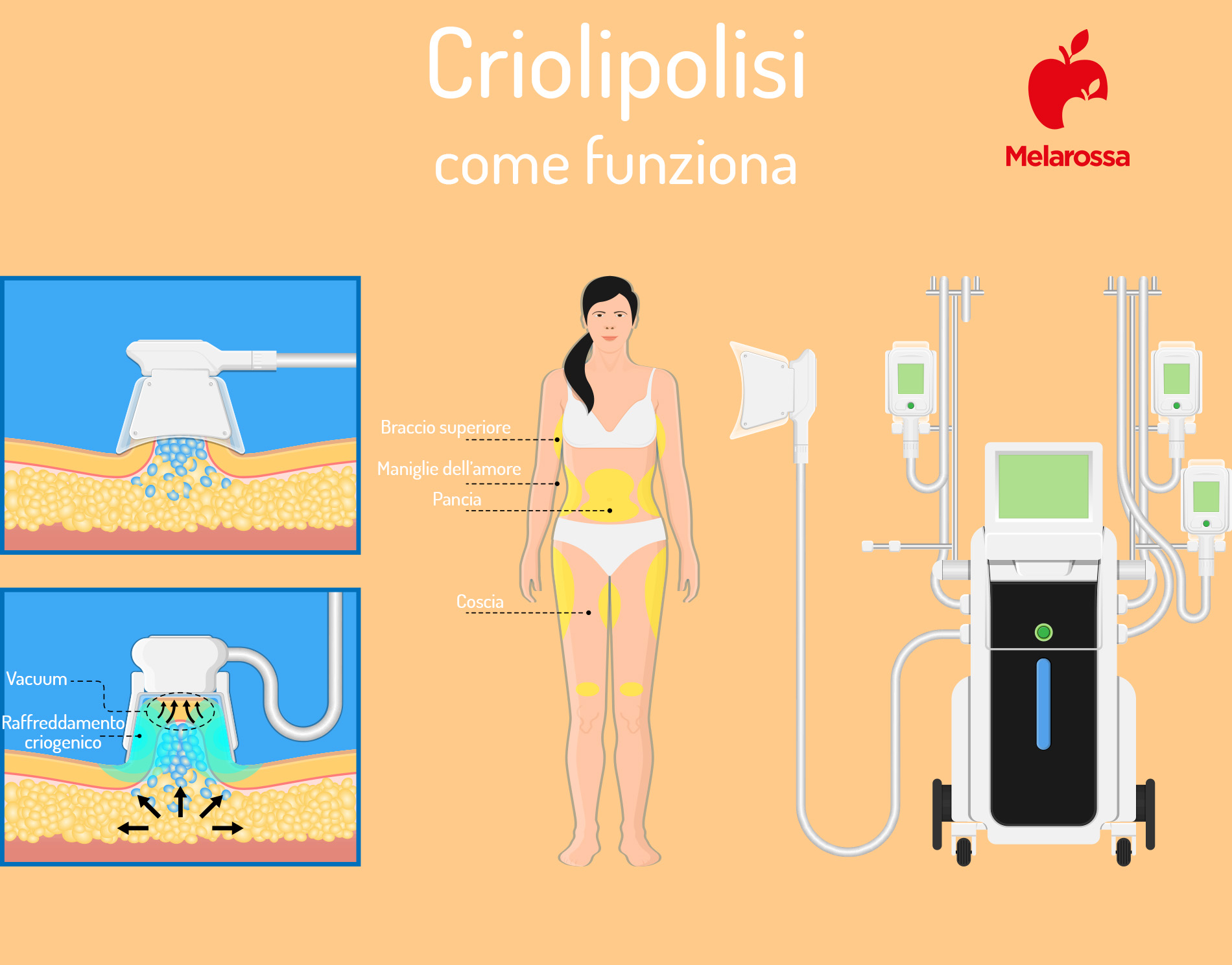 criolipolisi: come funziona