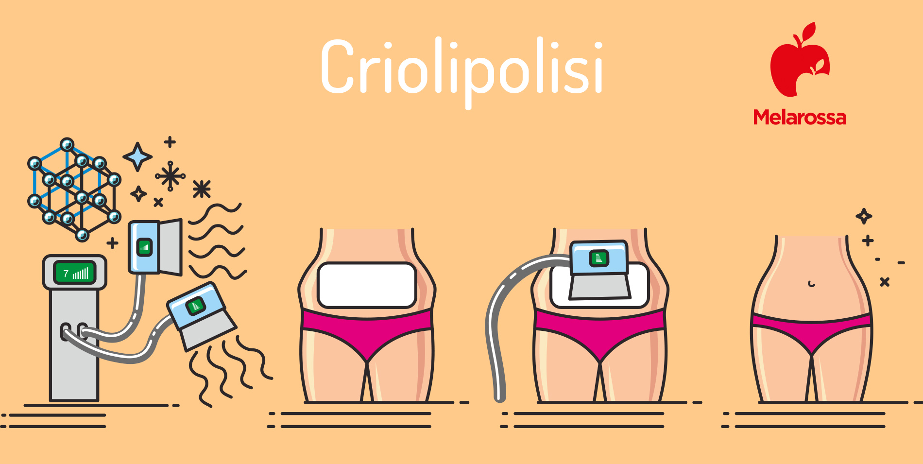 criolipolisi: prima e dopo 