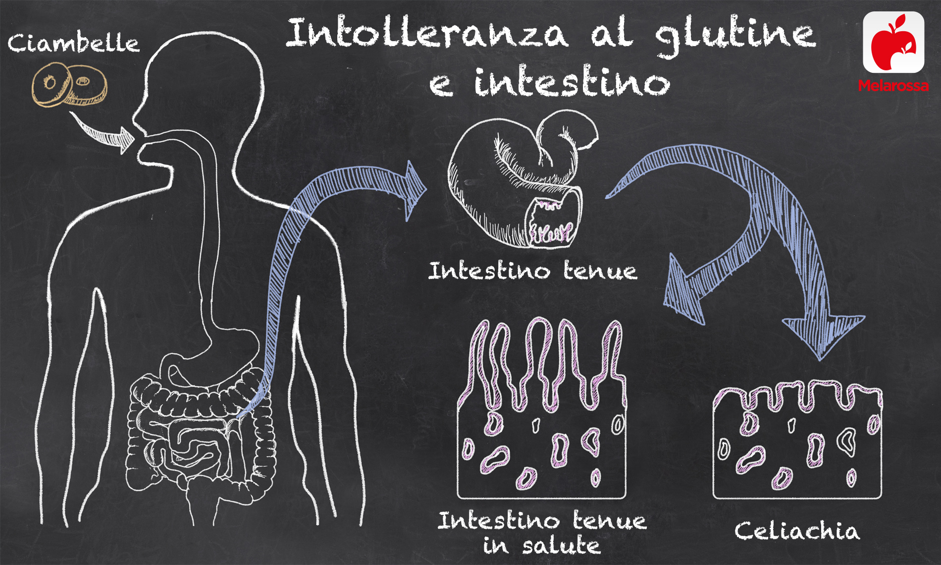 intolleranza al glutine e intestino