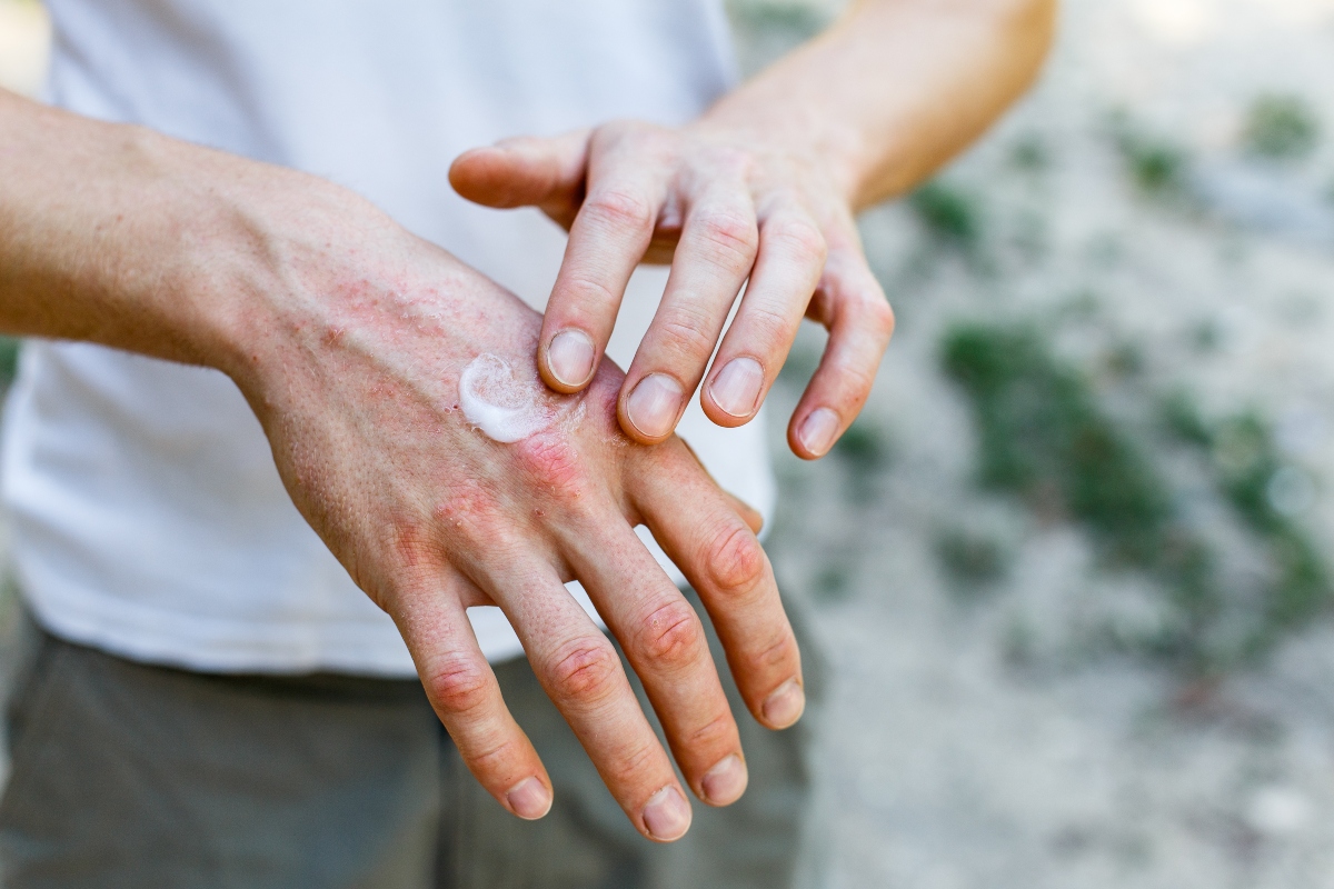 Ragadi alle mani: cosa sono, cause, sintomi, cure e prevenzione