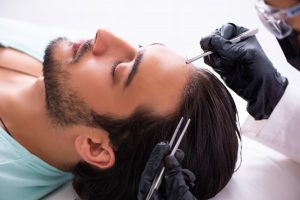 Trapianto capelli: cos’è, costo e come funziona