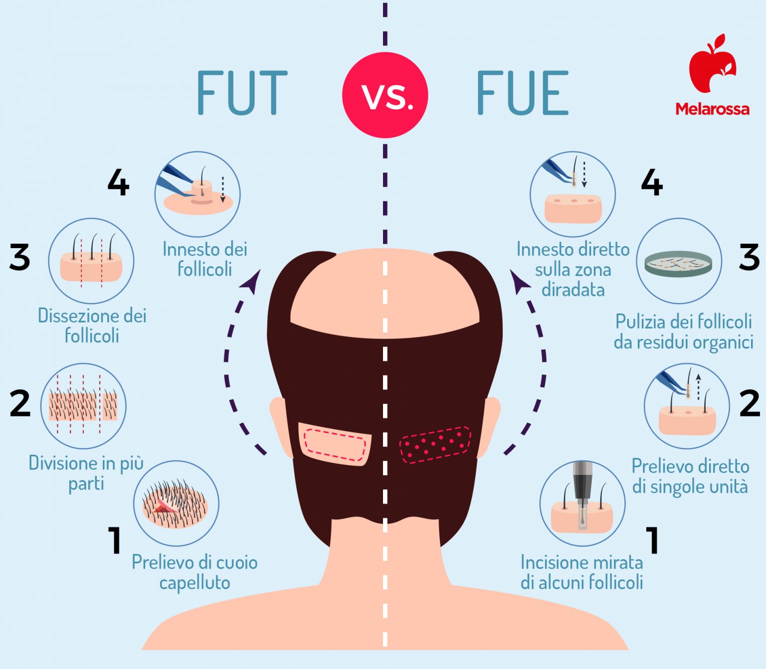 Trapianto capelli cos'è, quanto costa e come funziona Melarossa Trapianto capelli cos'è, quanto costa e come funziona Melarossa