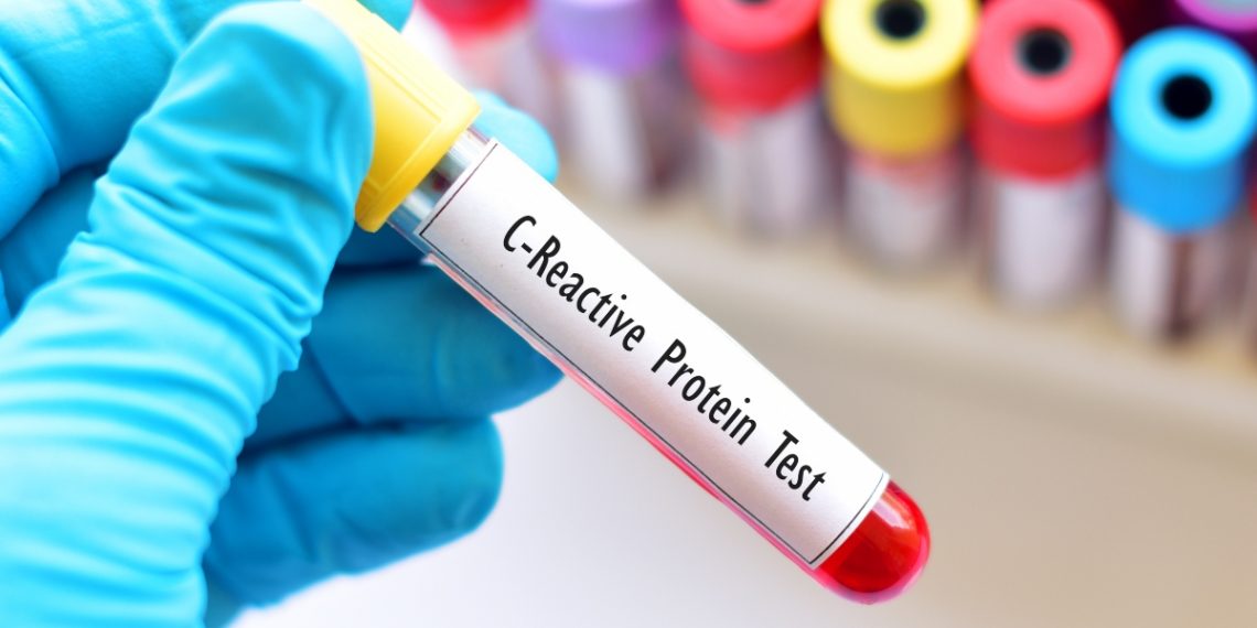 Proteina C reattiva cos’è, perché si