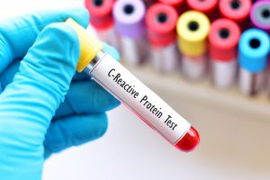 Proteina C reattiva: cos’è, quando e perché si misura, valori normali e cause valori bassi e alti