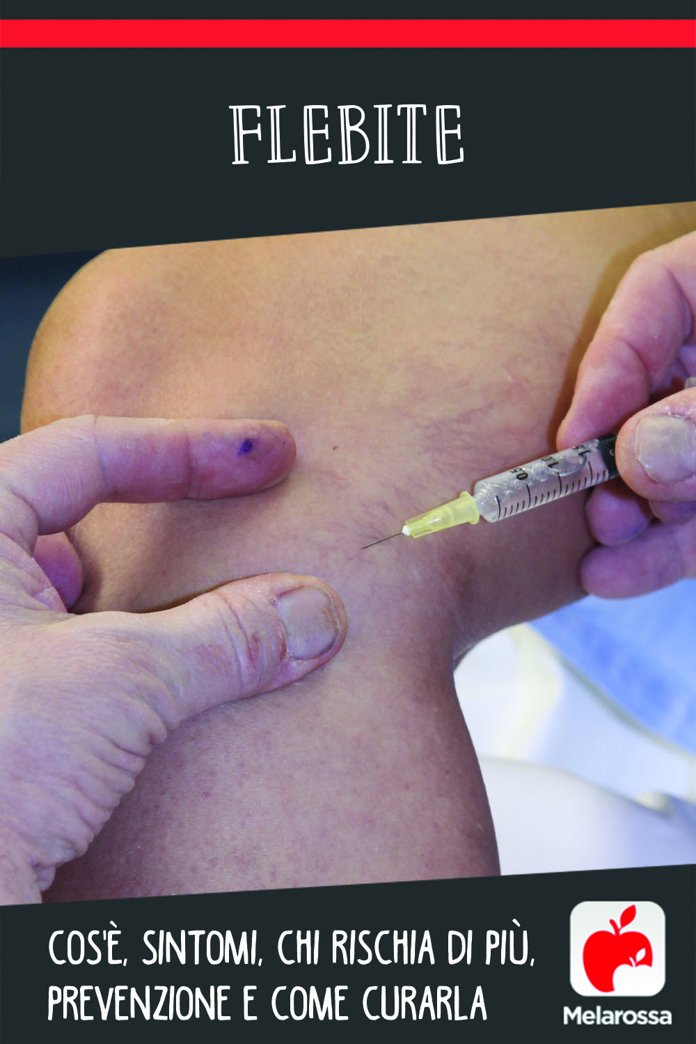 flebite: cos'è, cause, sintomi e cure