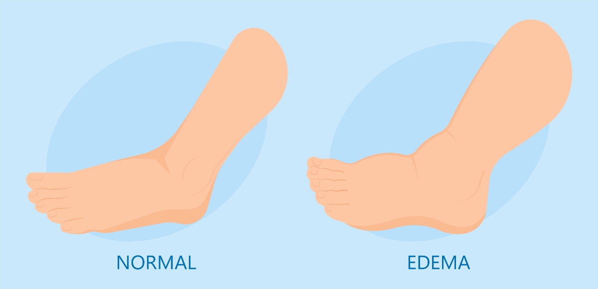 gambe gonfie: edema