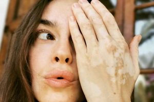 Giornata mondiale della vitiligine: la determinazione di Kasia Smutniak nell’affrontare la malattia
