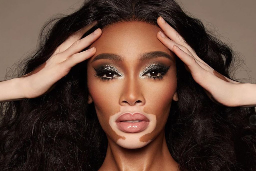 vitiligine winnie harlow