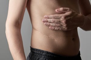 Pielonefrite: cos’è, sintomi, cause, diagnosi, cura e prevenzione