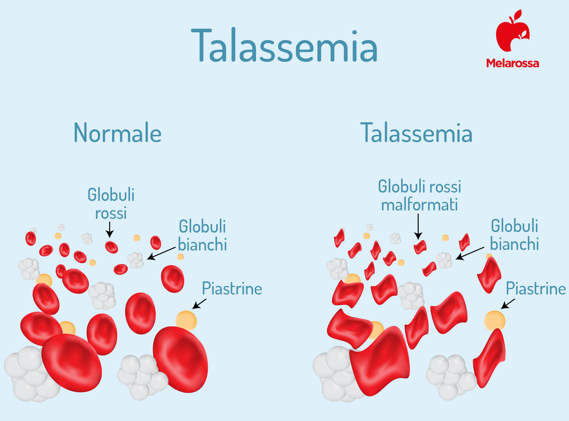 anemia mediterranea: globuli rossi 