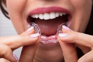 Bruxismo: cos’è, cause, sintomi, che tipo di bite scegliere, cure e rimedi naturali
