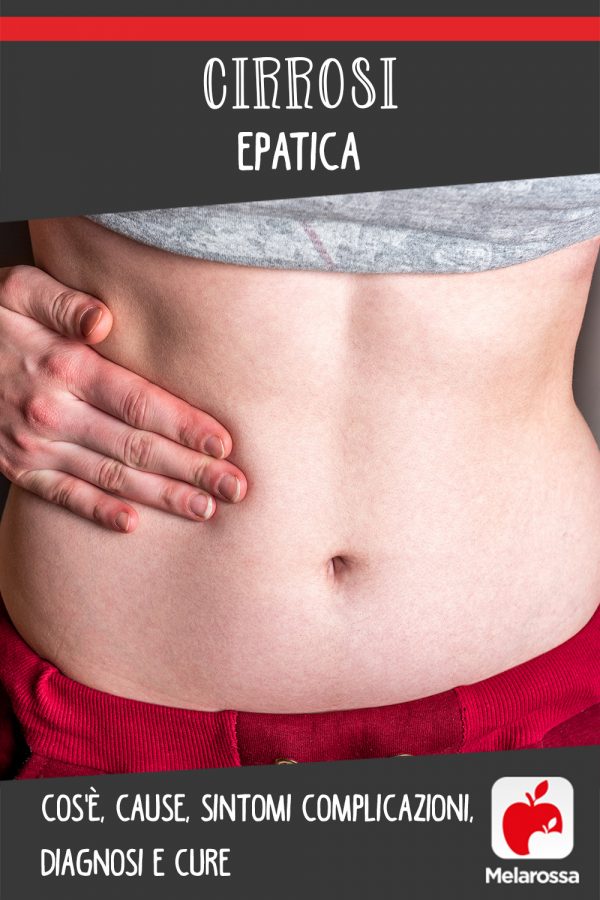 Cirrosi epatica cos'è, cause, sintomi complicazioni, diagnosi e cure Cirrosi epatica cos'è, cause, sintomi complicazioni, diagnosi e cure