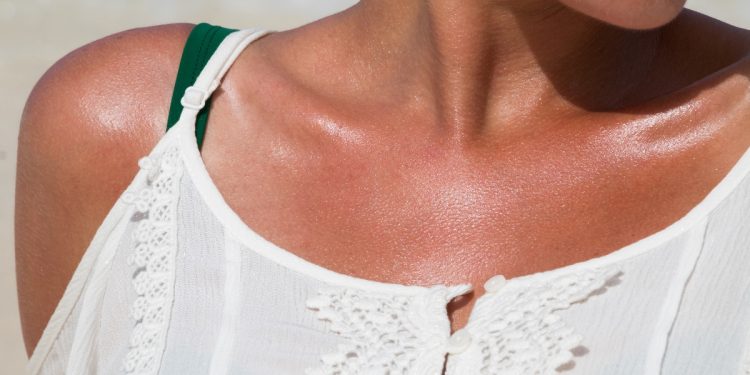 allergia al sole: una donna che presenta del rossore sul collo