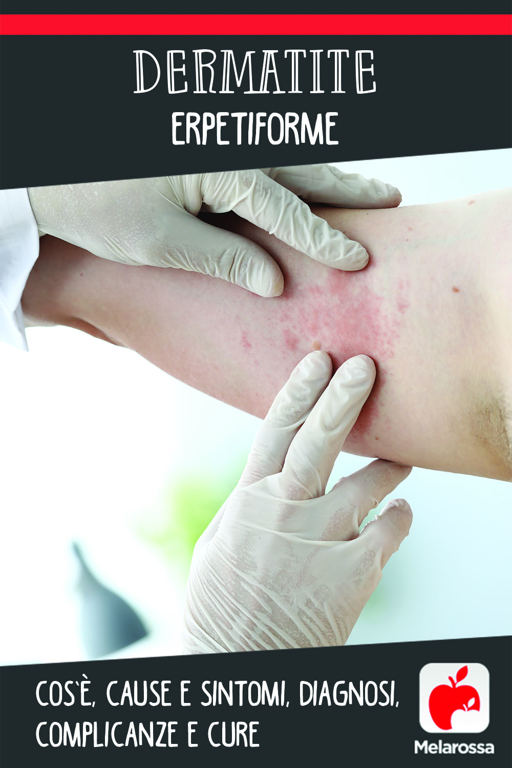 dermatite erpetiforme: cos'è cause, sintomi e cure