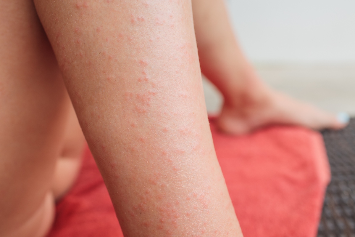 dermatite erpetiforme: cos'è e sintomi 