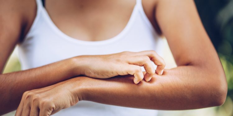 dermatite erpetiforme: cos'è, cause, sintomi, diagnosi e cure