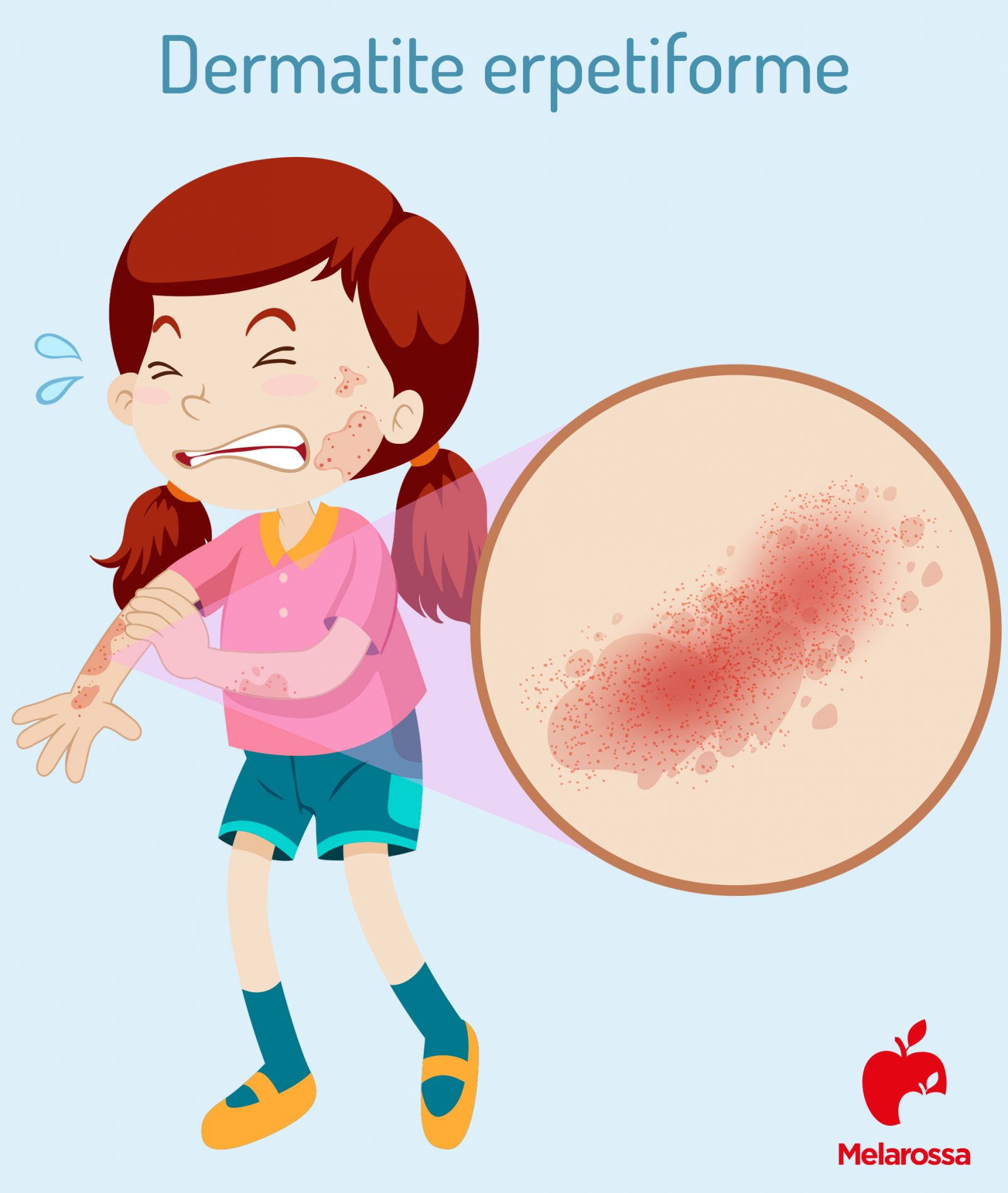 dermatite erpetiforme: soggetti a rischio 