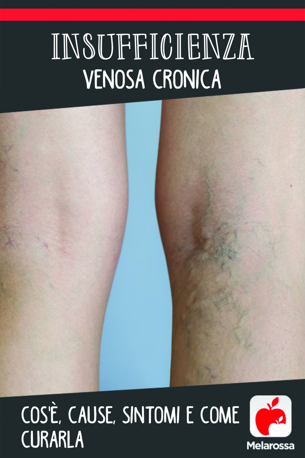 insufficienza venosa cronica: cos'è, cause, sintomi e cure