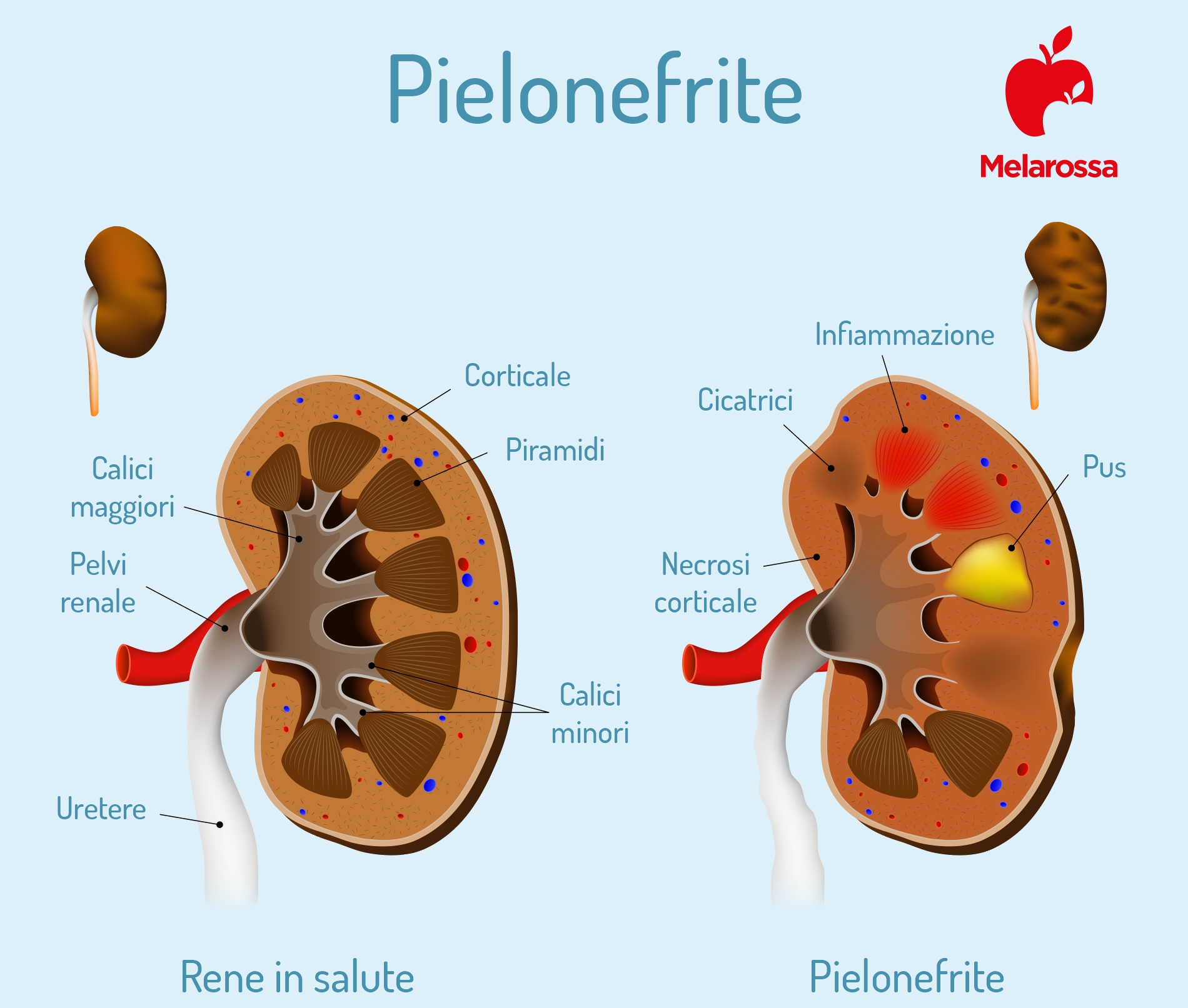Pielonefrite: infiammazione del rene 