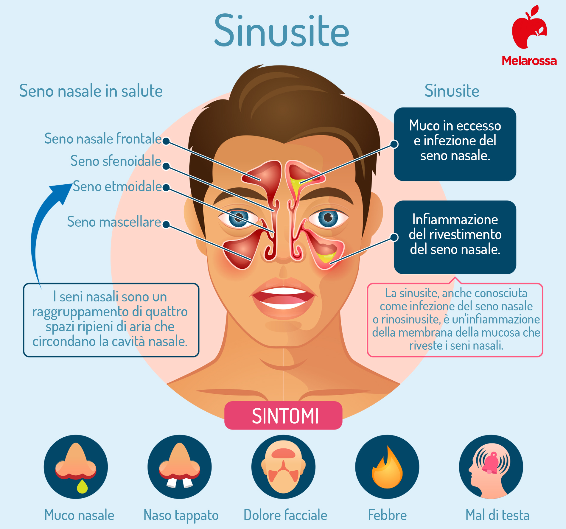 i sintomi della sinusite 