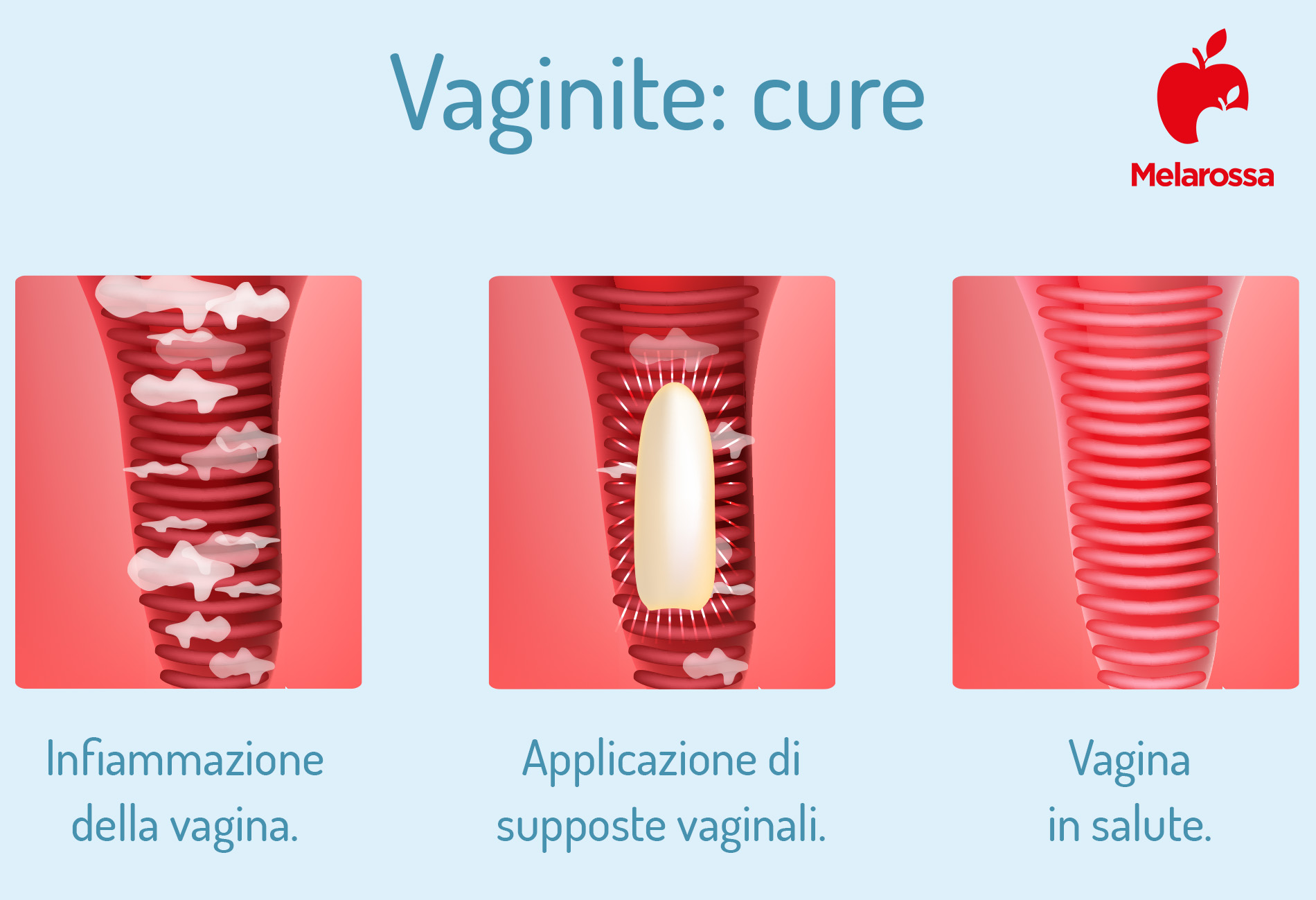 vaginite: cure 