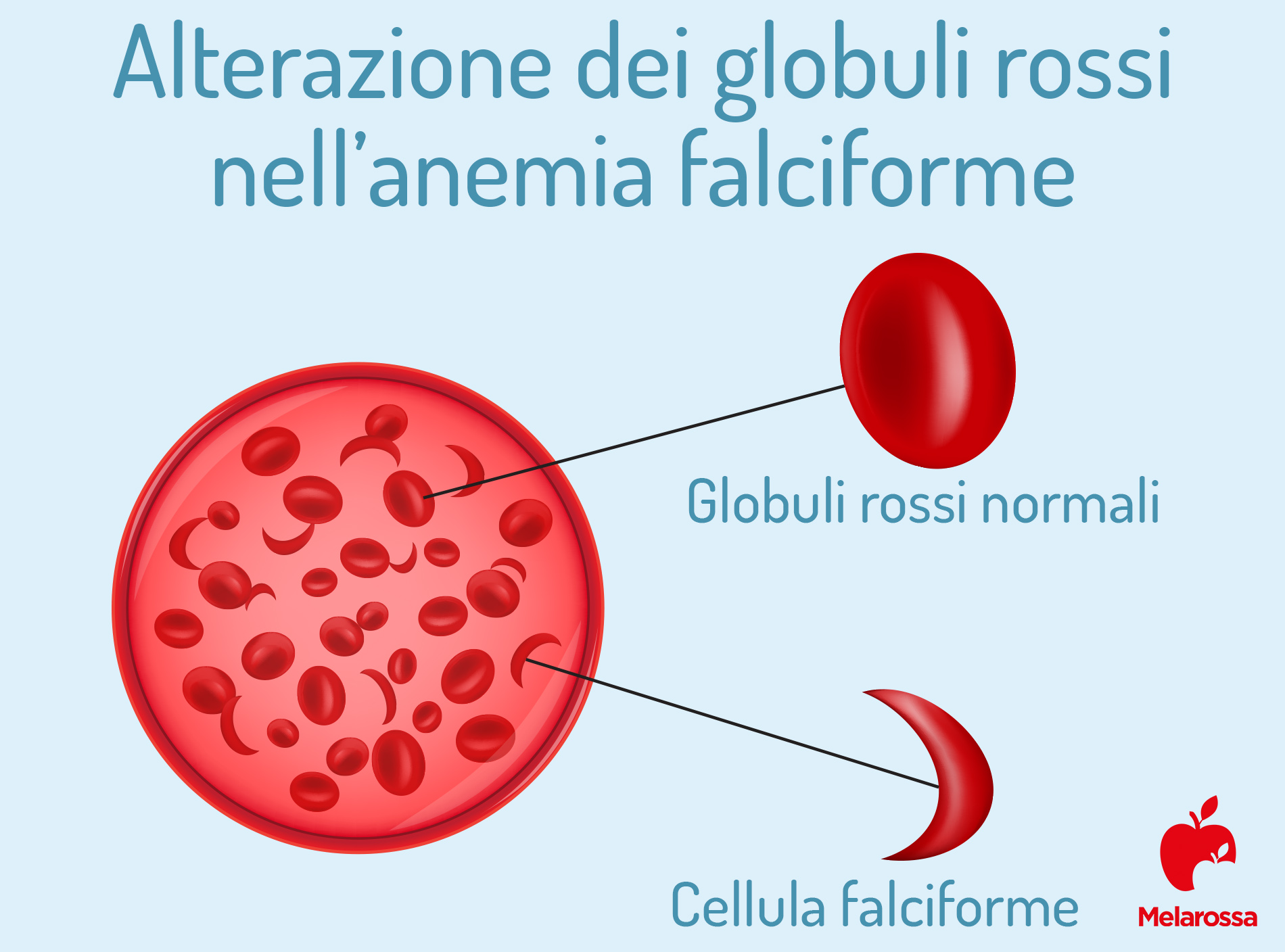 anemia falciforme alterazione globuli rossi