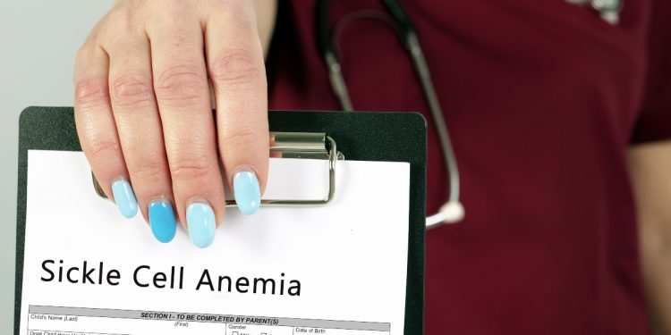 anemia falciforme: cos'è, cause, sintomi, diagnosi e cure