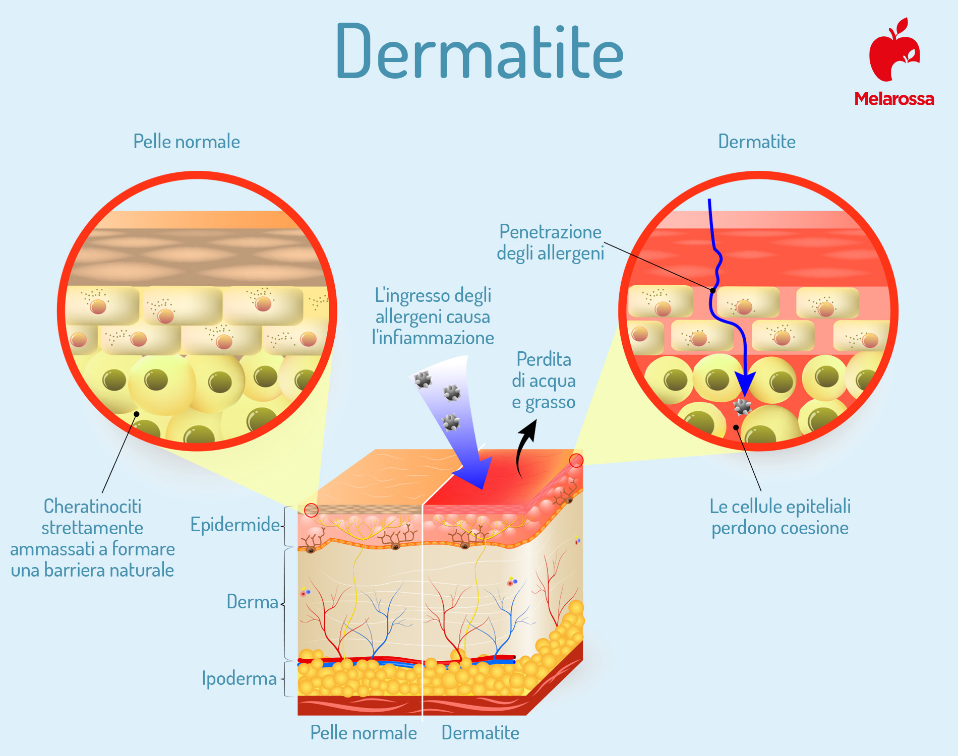 Dermatite