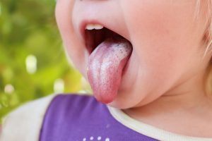 Mughetto: cos’è, cause,  come avviene il contagio, sintomi, cure e prevenzione