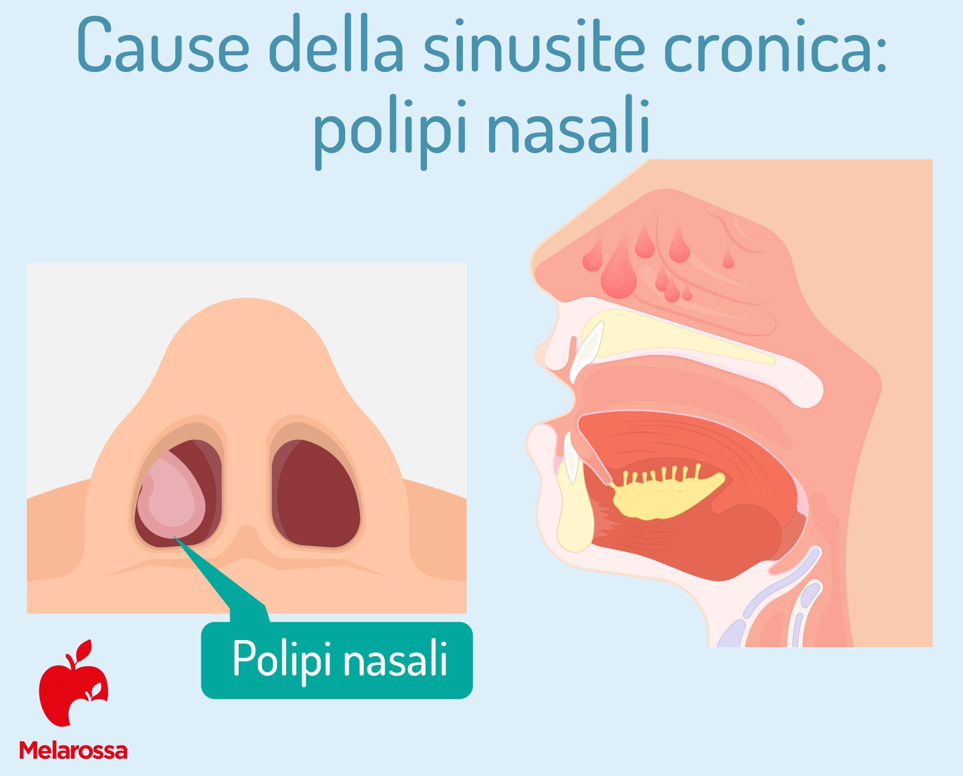 Cause della sinusite cronica: polipi nasali