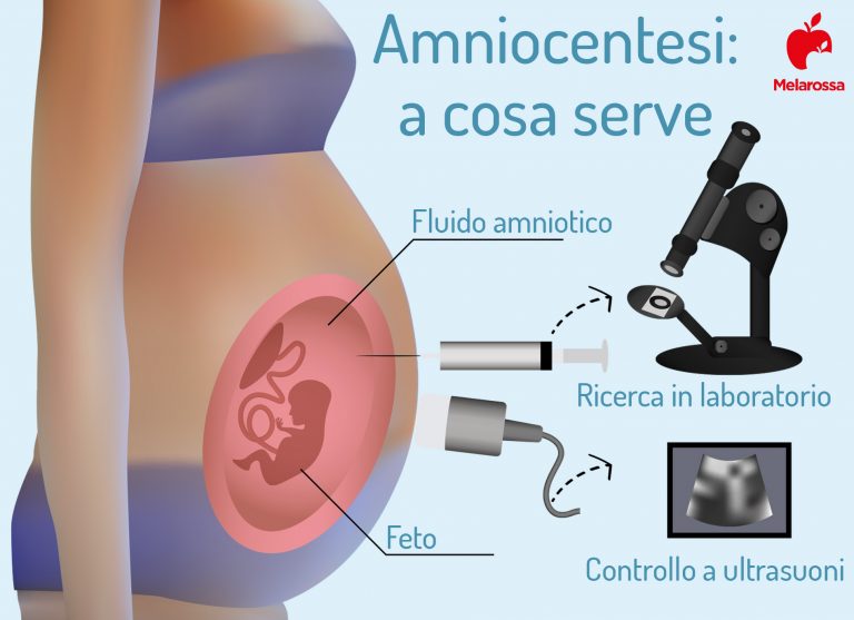 Amniocentesi cos’è, quando farla, cosa si vede, rischi e costi