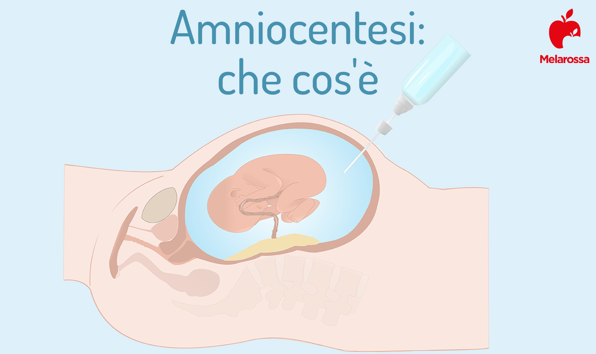 amniocentesi: che cos'è