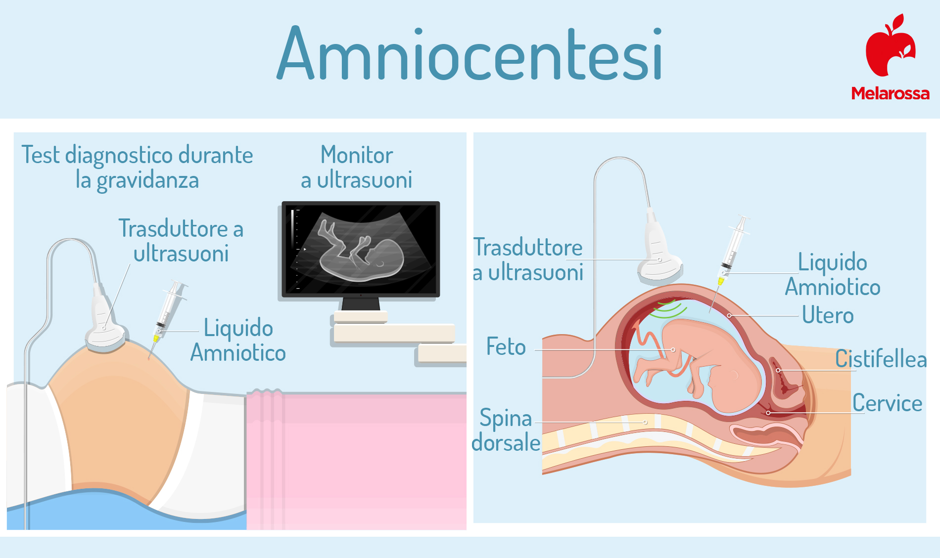 amniocentesi : come si svolge