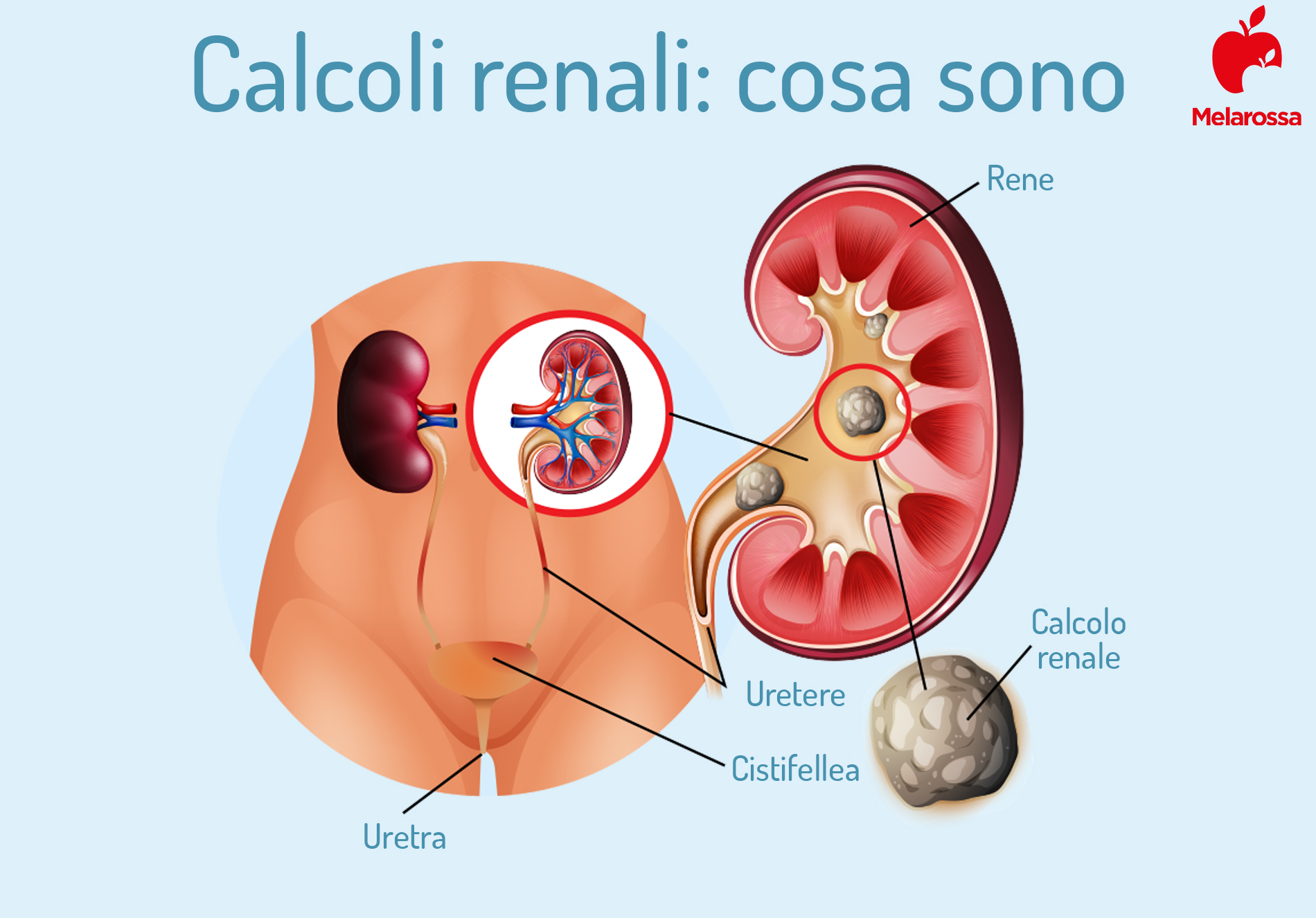 calcoli renali: cosa sono