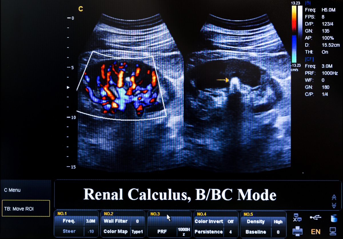radiografia: calcoli renali 