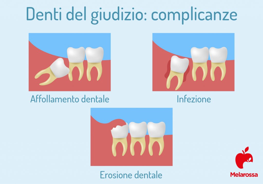 Denti del giudizio quali sono, sintomi e complicanze, quando toglierli