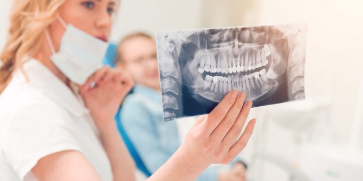 Denti del giudizio: cosa sono, sintomi, complicanze, quando toglierli