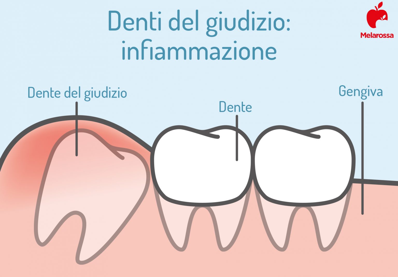 Denti del giudizio quali sono, sintomi e complicanze, quando toglierli
