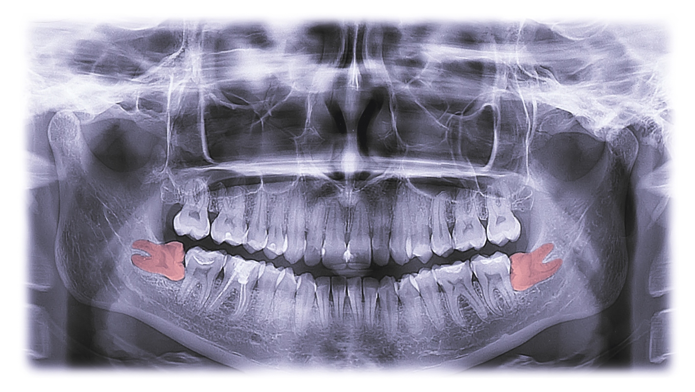 denti del giudizio: radiografia