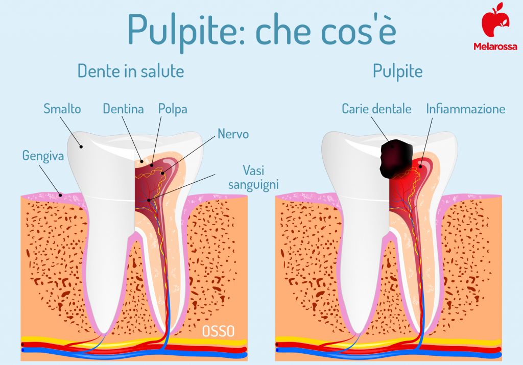 Pulpite Pulpite dentale: cos'è, tipi, cause, sintomi cure e prevenzione