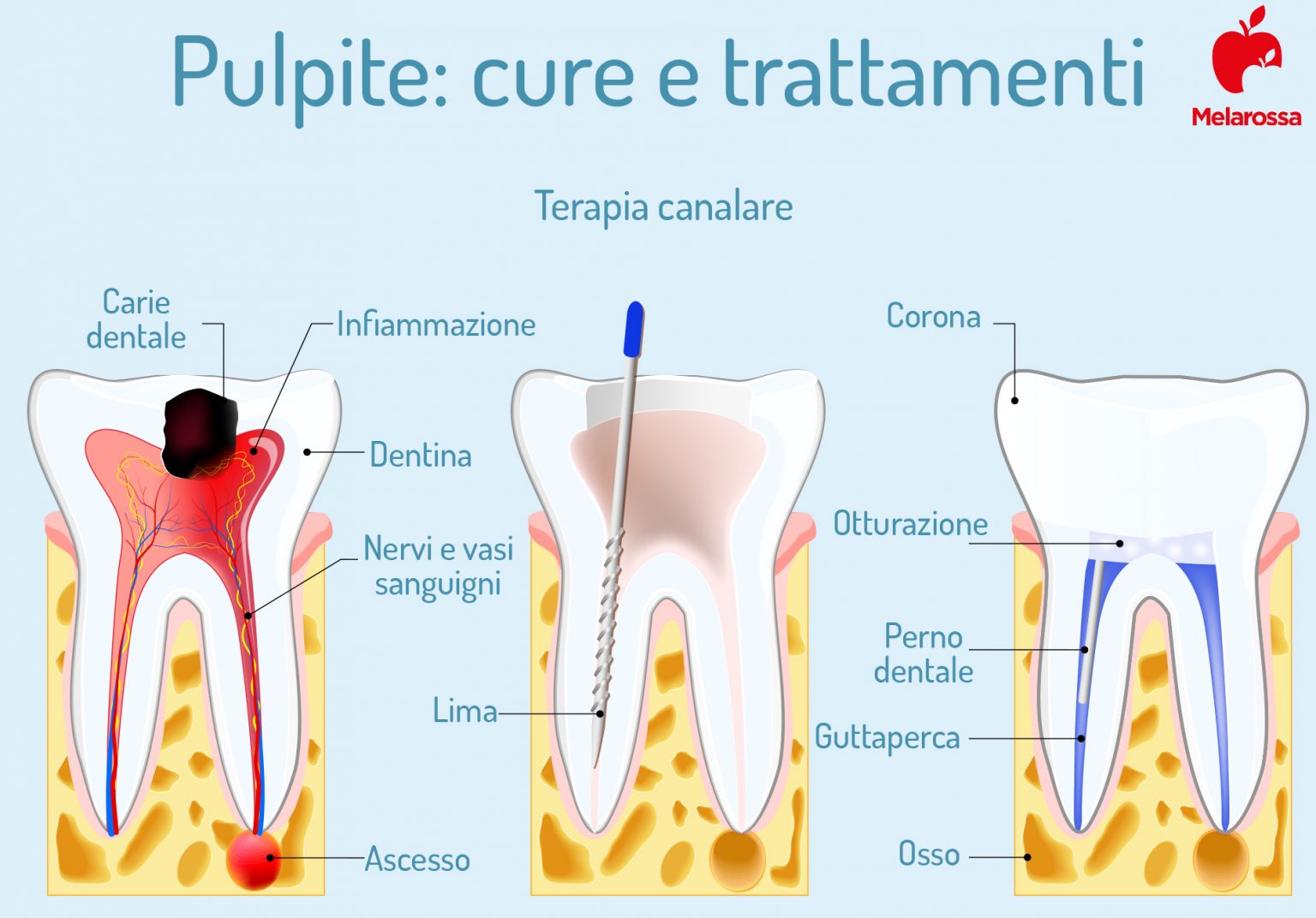 Pulpite Pulpite dentale: cos'è, tipi, cause, sintomi cure e prevenzione